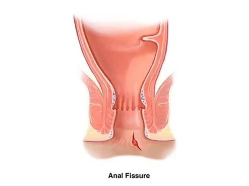 Piles Doctor in Chhattisgarh