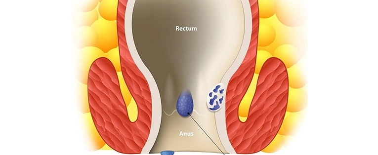 Fistula Surgery in Chhattisgarh