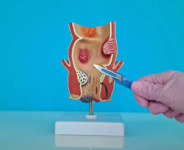 Piles Doctor in Chhattisgarh