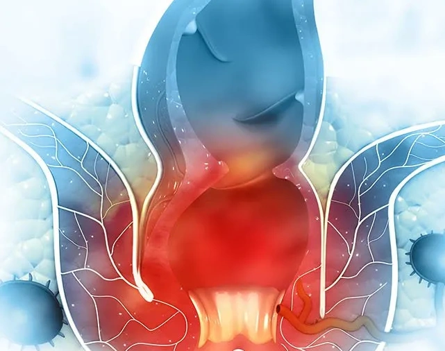 Fistula Surgery in Chhattisgarh