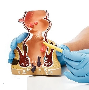 Piles Doctor in Chhattisgarh